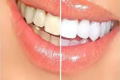 Diş beyazlatma tedavisi